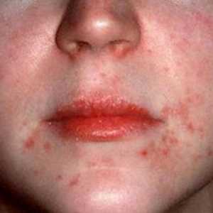 Uzroci simptomi i liječenje potkožnog grinja na licu