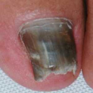 Uzroci simptomi i tretman noktiju onikomikoza