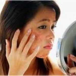 Uzroci akni na licu i kako da biste dobili osloboditi od njih