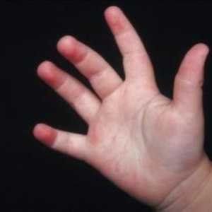 Znak bilo koje bolesti je osip u djeteta noge i ruke