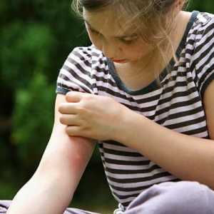 Prevencija i liječenje komarac ugrize kod djece
