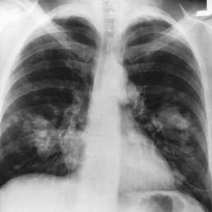 Karcinom pluća: Koliko živjeti? Trebam li vjerovati prognoze?