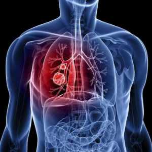 Rak pločastih stanica pluća: opis, uzroci, dijagnoza i liječenje značajke