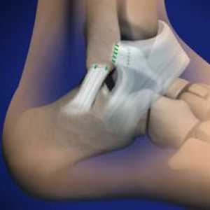 Istezanje ligamenata stopala - simptomi i liječenje
