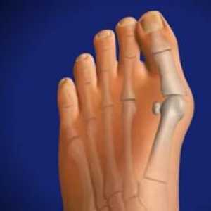 Uzgoj kost u stopalu: uzroci, simptomi, liječenje