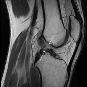 Rupture prednjeg križnog ligamenta: zašto se to događa i kako to popraviti?