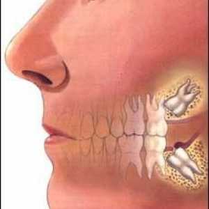 Utjecali zub - to jest, kako ga liječiti?