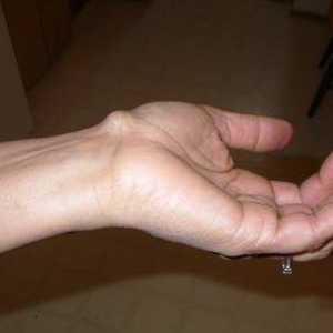 Paušalni pod kožu na ruci - to može biti i kako liječiti?