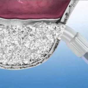 Sinus lift: korištenje u dentalnih implantata. Vrste, indikacije, moguće komplikacije