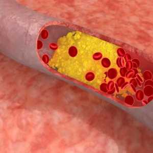 Savjeti o tome kako smanjiti kolesterol kod kuće