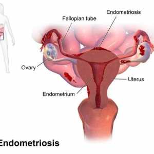 Spiralna „Mirena” Endometrioza: recenzije