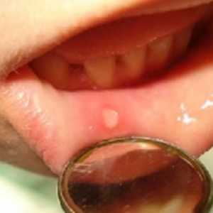 Stomatitis u djece. Simptomi bolesti