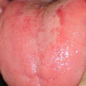 Pip jezik - uzroci, simptomi i liječenje