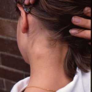 Povećani limfni čvor na vratu u djece. Što to znači?