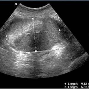 Karlica ultrazvuk kada učiniti: prije ili poslije menstruacije?