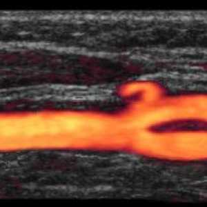 Vaskularni ultrazvuk - to je najsigurniji i najučinkovitiji način za istraživanje