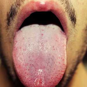 Saznajte što je uzrok bijele mrlje na jeziku u odraslih