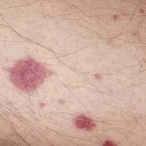 Vaskulitis - lezija od krvnih žila