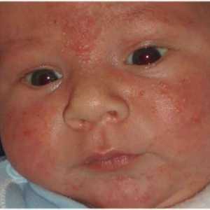 Vezikulopustulez novorođenčadi: patogena, simptoma i liječenje