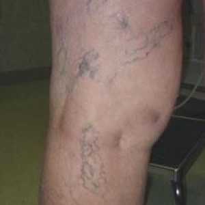 Vidljivi vene u nogama - uzrok proširenih vena?