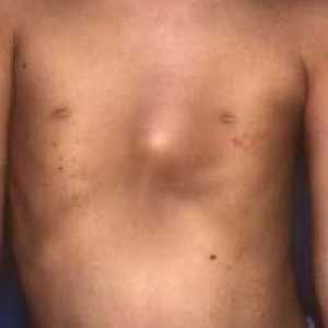 Lijevak prsa deformacija: mogućnosti i posljedice