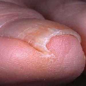 Ingrowing liječenje i prevencija noktiju