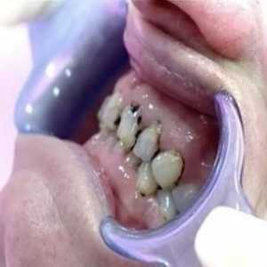 Zub se udaljio od zubnog mesa: zašto se to događa i kako se boriti?