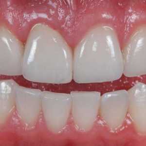 Keramičke zubi: Pregled, karakteristike i proizvodnju recenzije